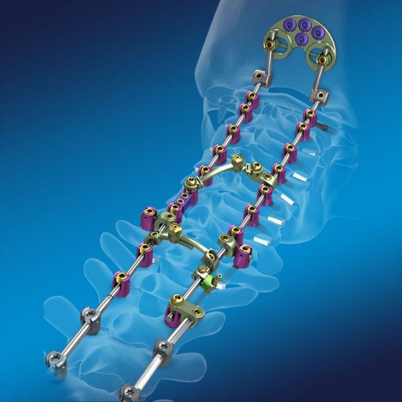 Occipito-cervico-thoracic spinal osteosynthesis unit / posterior / adult